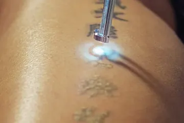 Laser Détatouage & Traitements Laser Visage à Lausanne