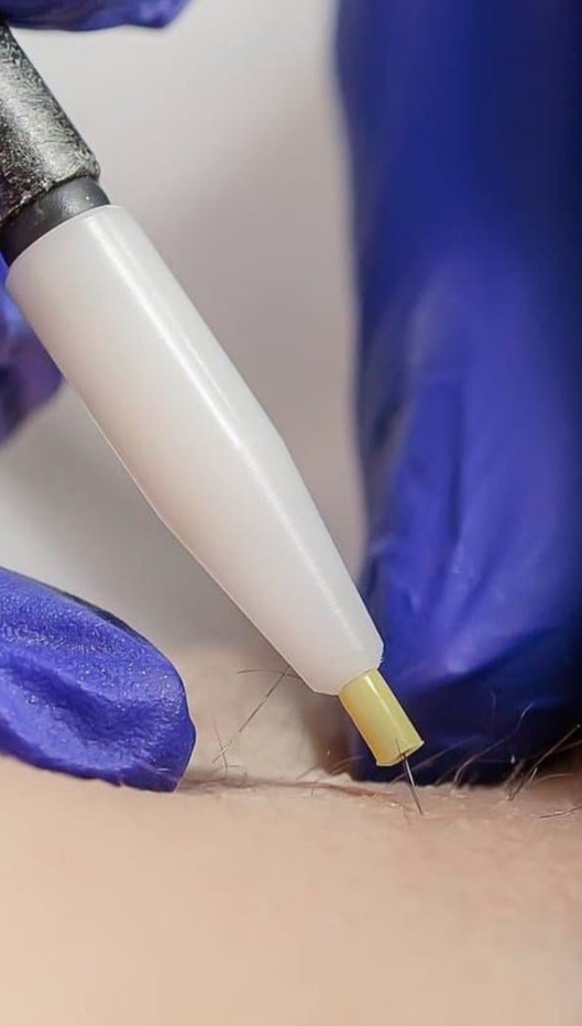 Illustration du follicule pileux et de l’électrolyse